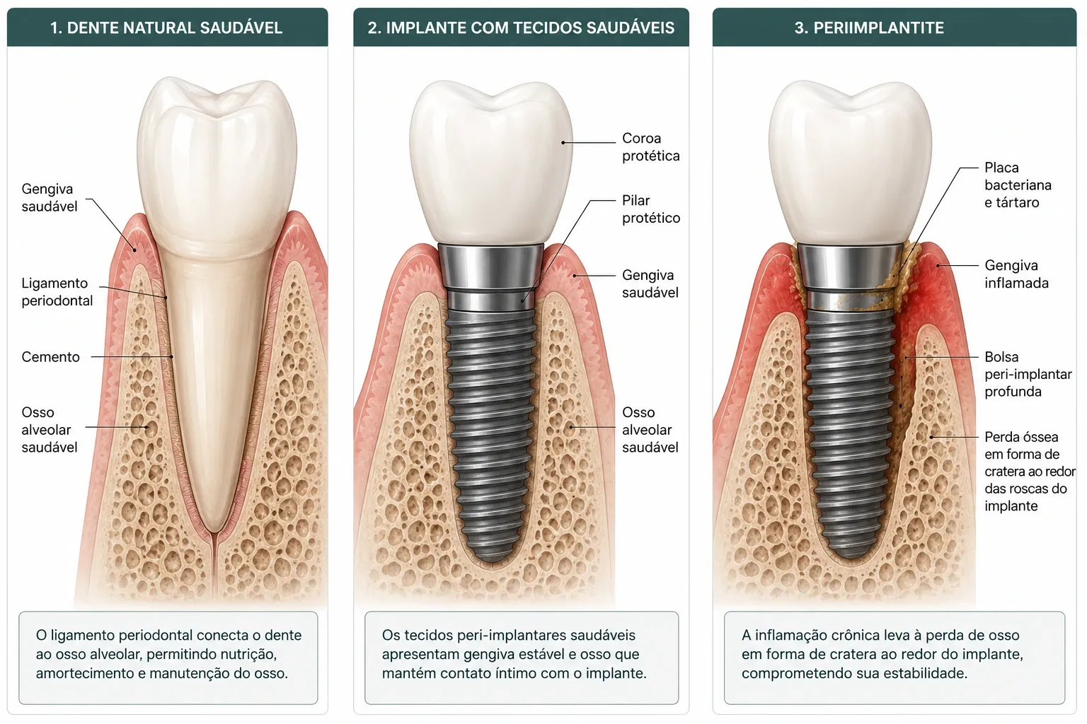 Comparação em três quadros. No primeiro, dente natural saudável, em que o ligamento periodontal conecta a raiz ao osso alveolar. No segundo, implante com tecidos saudáveis: coroa protética, pilar, gengiva estável e osso em contato direto com o implante, sem ligamento. No terceiro, periimplantite: placa bacteriana e tártaro junto ao pilar, gengiva inflamada, bolsa peri-implantar profunda e perda óssea em forma de cratera ao redor das roscas do implante.