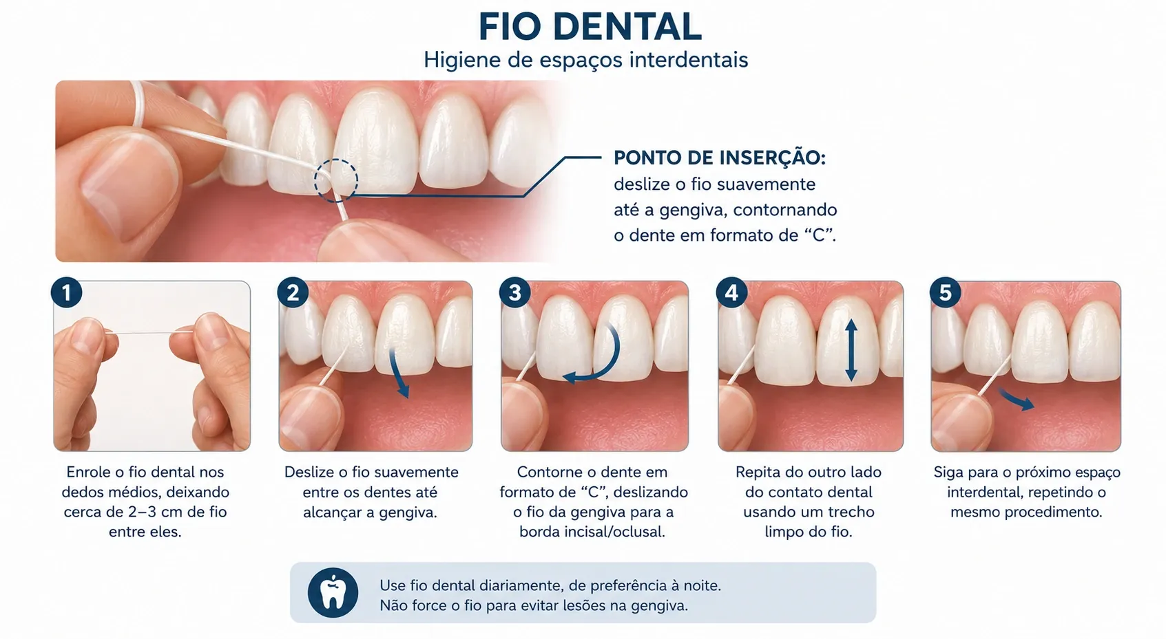 Higiene dos espaços entre os dentes com fio dental, em cinco passos. Primeiro, enrolar cerca de 2 a 3 cm de fio nos dedos médios. Segundo, deslizar o fio suavemente entre os dentes até alcançar a gengiva. Terceiro, contornar o dente em formato de C, deslizando o fio da borda da gengiva para a borda incisal. Quarto, repetir do outro lado do contato entre os dentes, com um trecho limpo do fio. Quinto, seguir para o próximo espaço. Um destaque no alto indica o ponto de inserção junto à gengiva. Ao pé da figura, a recomendação de usar fio diariamente, de preferência à noite, sem forçar, para evitar lesão na gengiva.